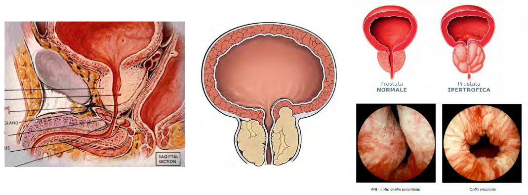 ipertrofia prostatica benigna)