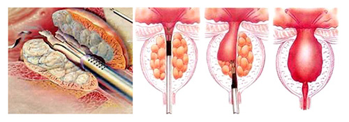 convalescenza dopo turp prostata