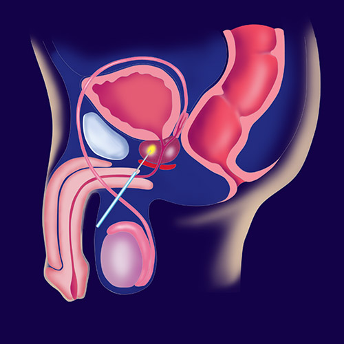 cosa significa prostata bilobata cosa significa prostata bilobata