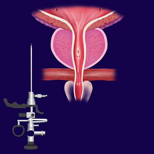 ipertrofia terzo lobo prostatico ipertrofia terzo lobo prostatico