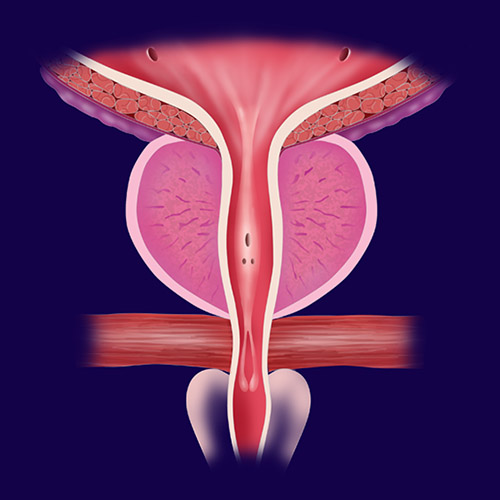 prostata disomogenea con adenoma bilobato